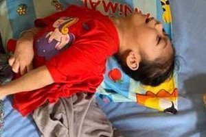 kisah-perjuangan-andini-tangani-cerebral-palsy-dan-gizi-buruk