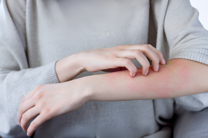 tips-merawat-kulit-alergi-agar-tetap-nyaman-dan-sehat